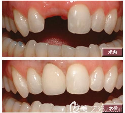 在長沙美奧口腔做半口種植牙效果圖 在長沙美奧口腔做半口種植牙效果圖