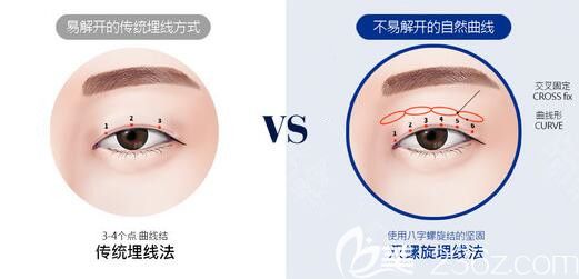 韓國夢想整形醫(yī)院雙螺旋埋線雙眼皮與普通埋線雙眼皮區(qū)別