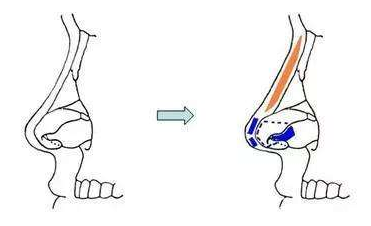 西安畫美鼻綜合手術