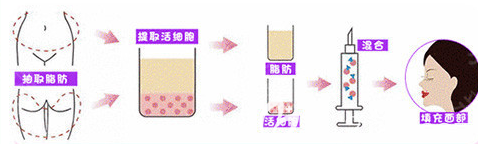 西安畫美自體脂肪填充手術