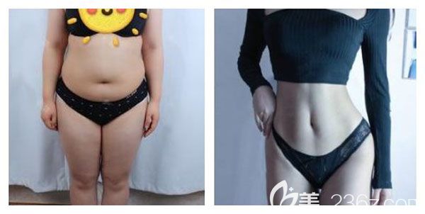 陳寧做完腰腹吸脂+大腿抽脂案例對比圖
