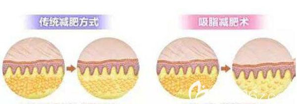 昆明韓辰360幸福吸脂的優(yōu)勢