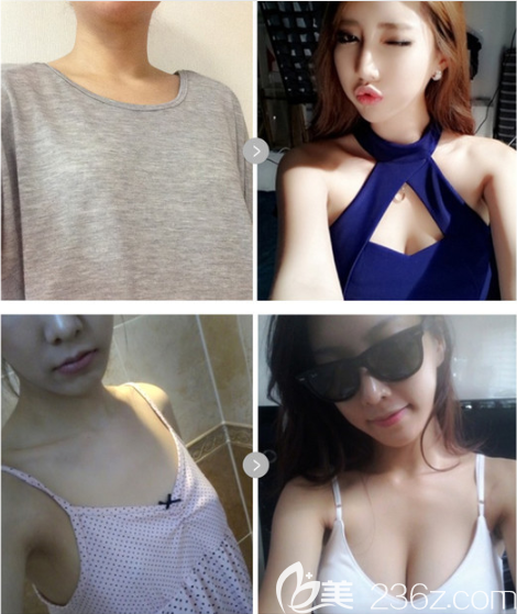 歐佩拉蓓菈假體隆胸