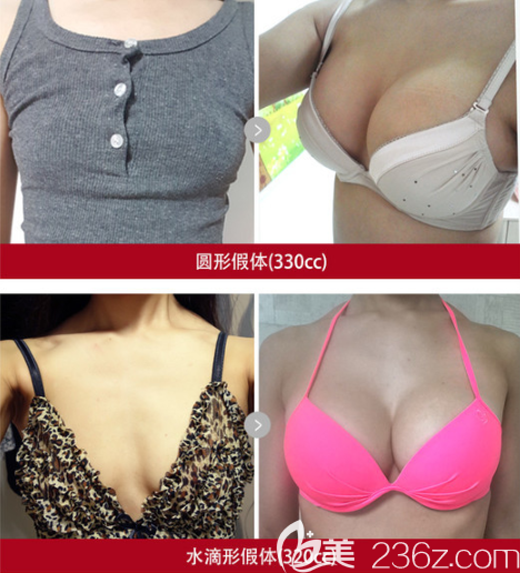 圓形330cc和水滴形320cc假體