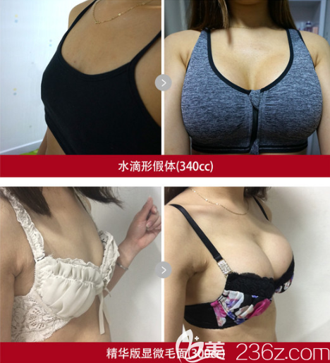 水滴形340cc和毛面300cc假體