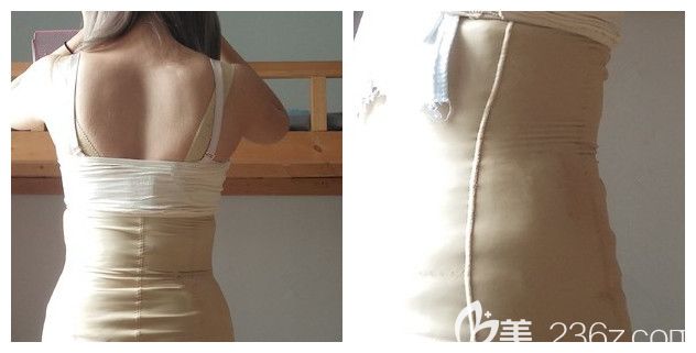 做完多維吸脂腰腹部穿戴塑身衣