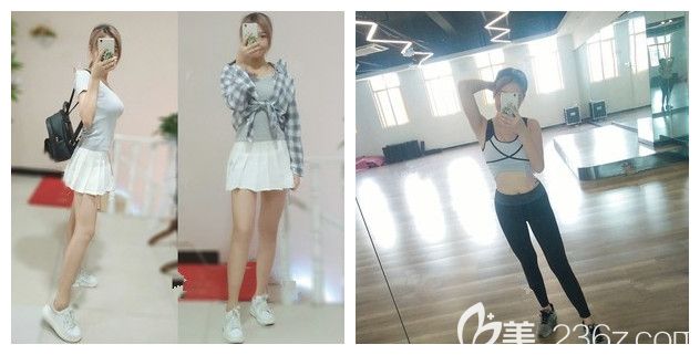 腰腹吸脂多久消腫見到效果?到連云港華美體驗(yàn)過的小仙女說術(shù)后一周就要換小碼塑身衣了