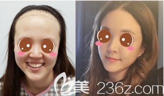 韓國毛杰琳整形醫(yī)院額頭縮小2.9cm+發(fā)際線矯正2400毛真人案例 韓國毛杰琳整形醫(yī)院額頭縮小2.9cm+發(fā)際線矯正2400毛真人案例