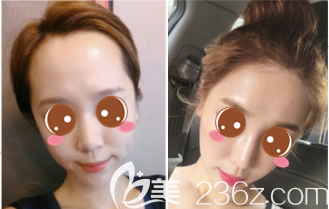 韓國額頭縮小哪家正規(guī)靠譜？韓國毛杰琳額頭縮小+發(fā)際線種植真人案例給你答案