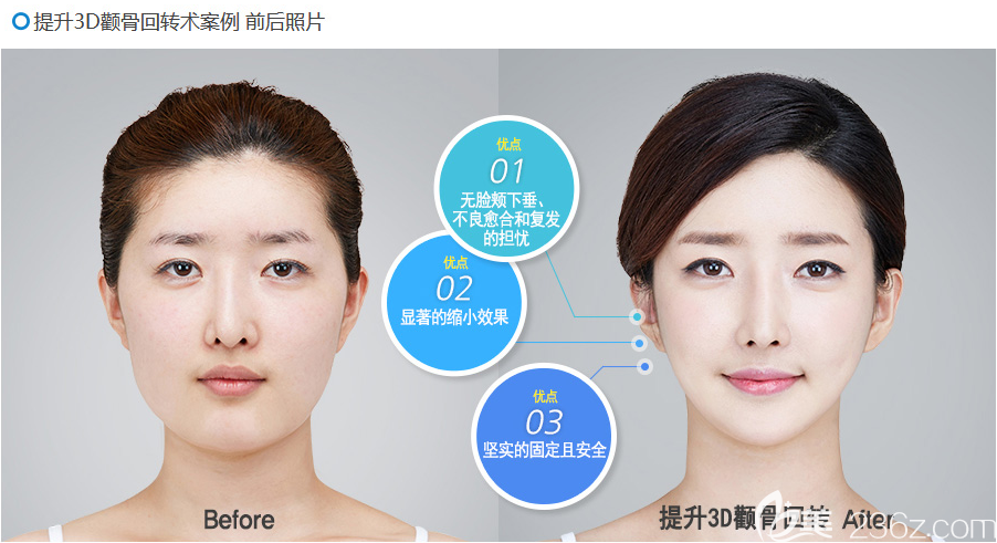韓國(guó)博朗溫金兌奎顴骨案例 韓國(guó)博朗溫金兌奎顴骨案例