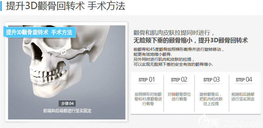 韓國(guó)博朗溫金兌奎顴骨手術(shù)方法示意圖 韓國(guó)博朗溫金兌奎顴骨手術(shù)方法示意圖