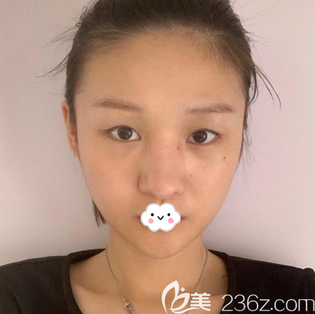 去深圳富華醫(yī)院做雙眼皮術(shù)前照片 去深圳富華醫(yī)院做雙眼皮術(shù)前照片