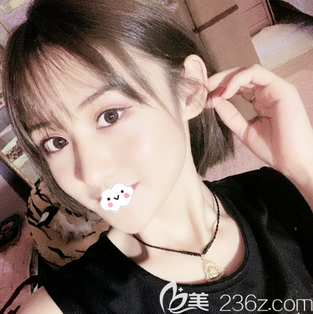 來(lái)看深圳富華醫(yī)院金順女做的雙眼皮案例 來(lái)看深圳富華醫(yī)院金順女做的雙眼皮案例