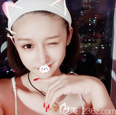 深圳富華醫(yī)院全切雙眼皮一個(gè)月自拍 深圳富華醫(yī)院全切雙眼皮一個(gè)月自拍