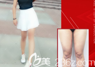 大腿環(huán)吸的術(shù)前術(shù)后對(duì)比圖 大腿環(huán)吸的術(shù)前術(shù)后對(duì)比圖