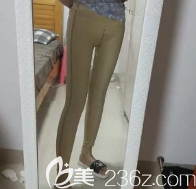 做完大腿環(huán)吸手術(shù)后的第五天 做完大腿環(huán)吸手術(shù)后的第五天