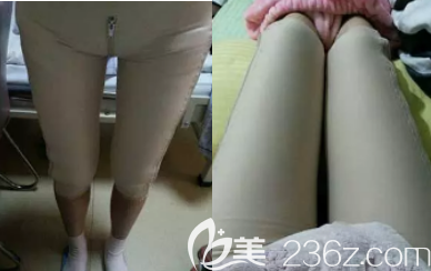 做完大腿環(huán)吸手術(shù)后的第16天 做完大腿環(huán)吸手術(shù)后的第16天