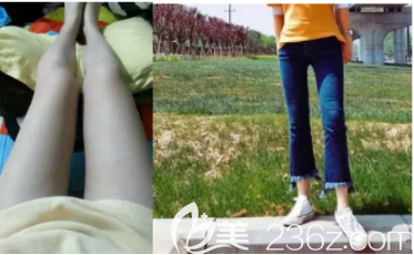 梨型身材的我終于在西安葉子整形醫(yī)院做了大腿環(huán)吸手術(shù)后恢復(fù)的挺好的