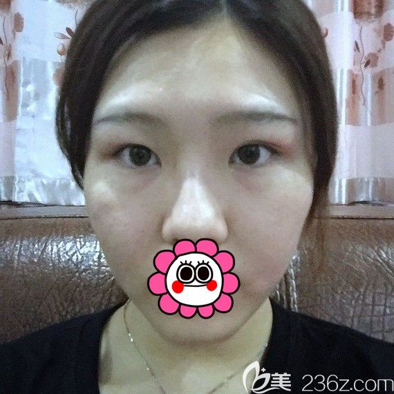 到溫州藝星修復(fù)前的雙眼皮 到溫州藝星修復(fù)前的雙眼皮