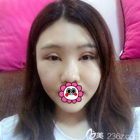 雙眼皮修復(fù)術(shù)后五天 雙眼皮修復(fù)術(shù)后五天