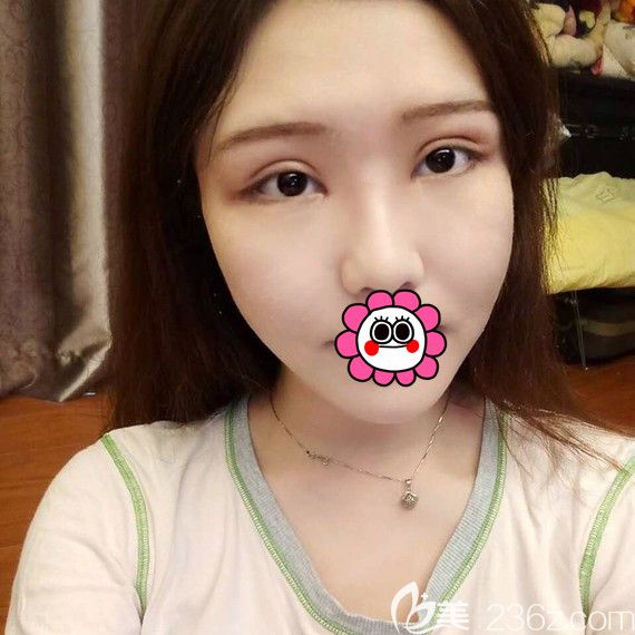 溫州藝星雙眼皮修復(fù)8天 溫州藝星雙眼皮修復(fù)8天