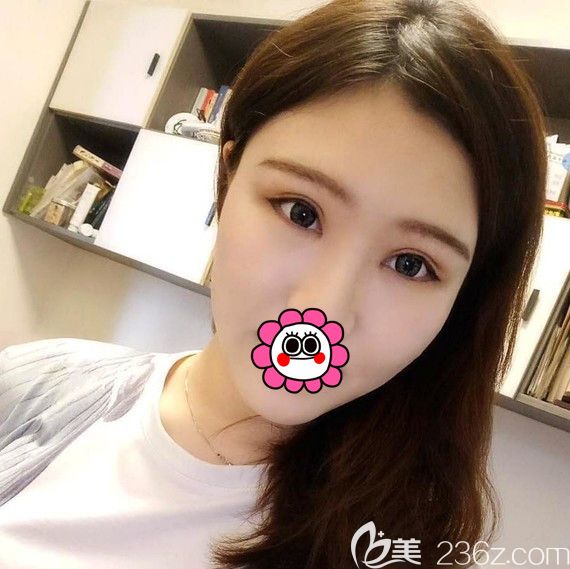 雙眼皮修復(fù)一個月<span style= 雙眼皮修復(fù)一個月<span style=