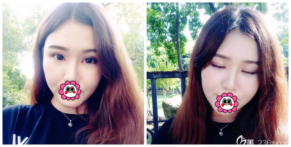 感謝媽媽幫我找溫州藝星眼整形醫(yī)做了雙眼皮修復(fù)后變的更美了