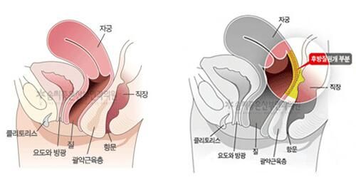 韓國好手藝后方膣圓蓋術(shù)介紹