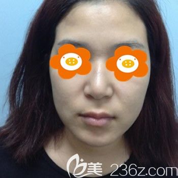 福州臺江整形李文信為我做鼻子前照片 福州臺江整形李文信為我做鼻子前照片