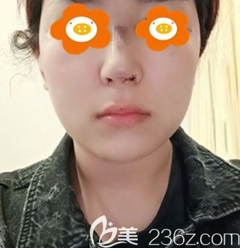 誰說千萬別去福州臺(tái)江整形，我覺得林麗德為我做肋骨鼻綜合效果就挺不錯(cuò)