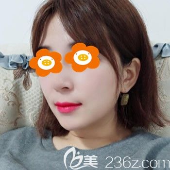 找福州臺江李文信隆鼻鼻術(shù)后9天圖片 找福州臺江李文信隆鼻鼻術(shù)后9天圖片