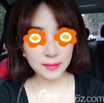 找福州臺江李文信做鼻綜合術(shù)后1個月照片 找福州臺江李文信做鼻綜合術(shù)后1個月照片