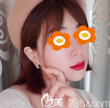 找福州臺江李文信做鼻子術(shù)后 找福州臺江李文信做鼻子術(shù)后