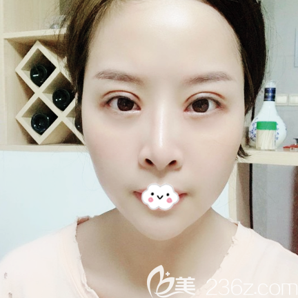 <!--<i data=20240703-sp></i>-->整形醫(yī)院脂肪填充案例20天效果圖 <!--<i data=20240703-sp></i>-->整形醫(yī)院脂肪填充案例20天效果圖