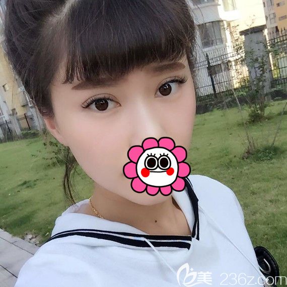 都說寧波雅韓龔濤做鼻子效果好，我覺著他給我做的雙眼皮效果也挺滿意的