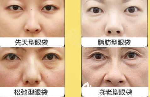 眼袋類型示意圖