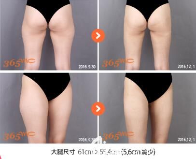 韓國(guó)365mc醫(yī)院吸脂瘦大腿真人前后對(duì)比照