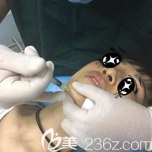 杜凱娟主任幫我注射伊婉玻尿酸術中即刻