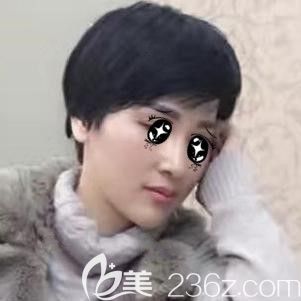 注射伊婉玻尿酸墊下巴術后25天下巴自然