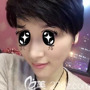 到太原時光做玻尿酸墊下巴術后45天恢復效果