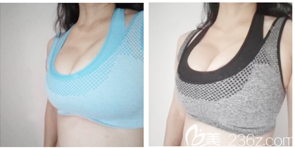 深圳奧美定取出哪家醫(yī)院醫(yī)生取得好？看完我找深圳南雅姚成紅做的胸部奧美定取出實例就知道