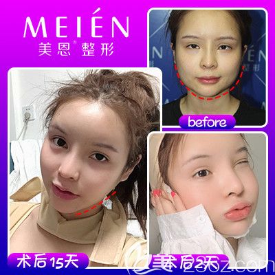 廣東廣州美恩徐威強(qiáng)長(zhǎng)曲線下頜角