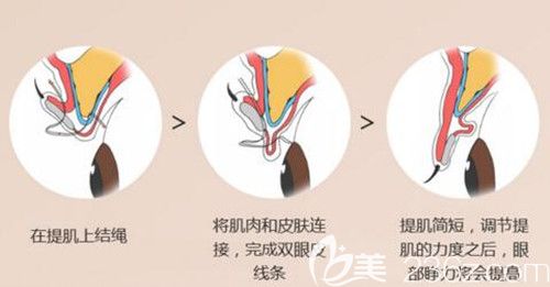 韓國(guó)艾恩非切開(kāi)手術(shù)法眼型矯正術(shù)示意圖