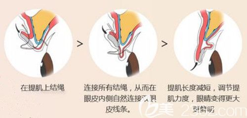 韓國(guó)艾恩切開(kāi)法眼型矯正術(shù)示意圖