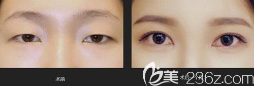 韓國(guó)艾恩真人眼型矯正術(shù)前術(shù)后對(duì)比照