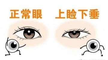 正常眼型和上瞼下垂眼型的對(duì)比照