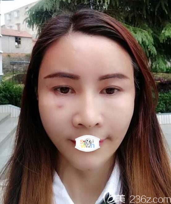 孝感天妃柳肖全臉脂肪填充術(shù)后第2天