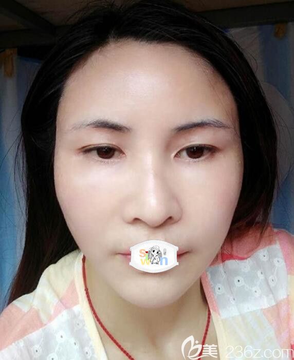 孝感整形哪里比較好？花1W多價格找孝感天妃柳肖做自體脂肪面部填充術(shù)后11天恢復(fù)自然