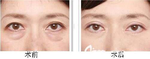 祛眼袋手術(shù)1-10天恢復(fù)效果圖