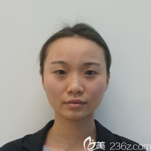 術(shù)前單眼皮照片 術(shù)前單眼皮照片